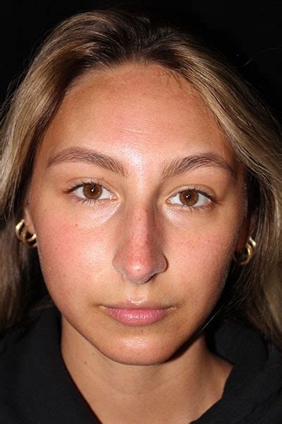 rhinoplasty nose surgery archives gowda md associates