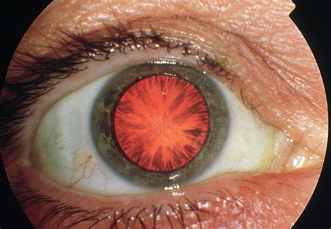 cataract  adults diagnosis  management gp eyes
