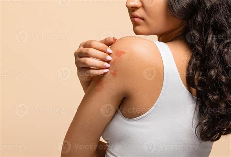 Unhappy young woman scratching her irritated skin on arm, annoyed