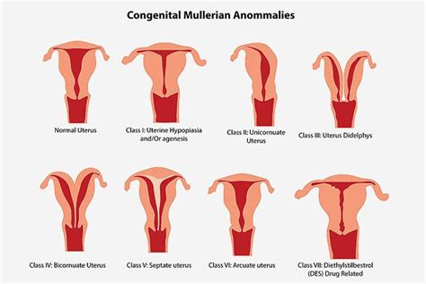 Uterine Abnormalities During Pregnancy - Classification, Symptoms ...