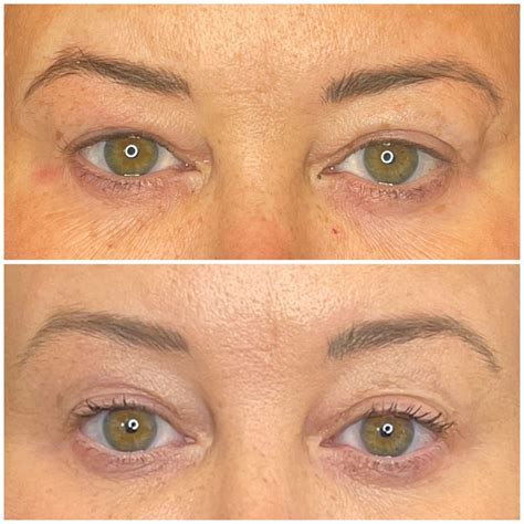 Skin Tightening in Calgary, AB | Beacon Dermatology