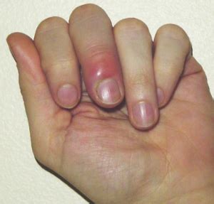 Finger and hand infections – Orthopaedia: Hand