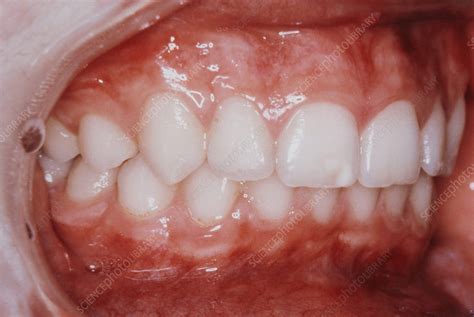 premolars showing interdigitation stock image  science