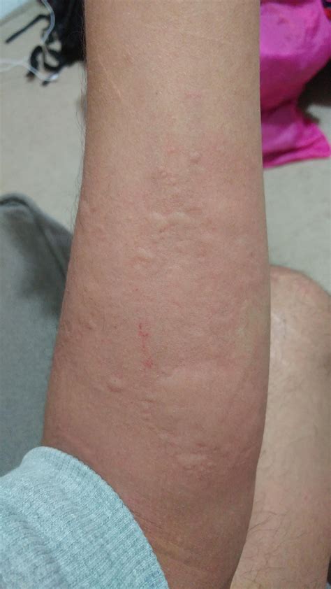 Do i have an std? Could this be syphilis from kissing, I'm a virgin : r/STD