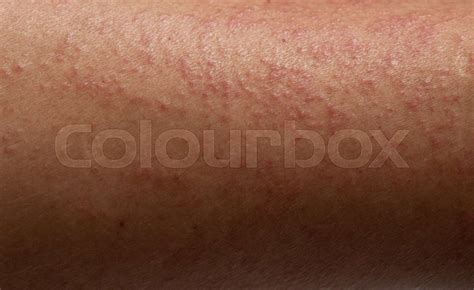 Strong allergic rashes on the leg , Dermatological rash on the skin and ...