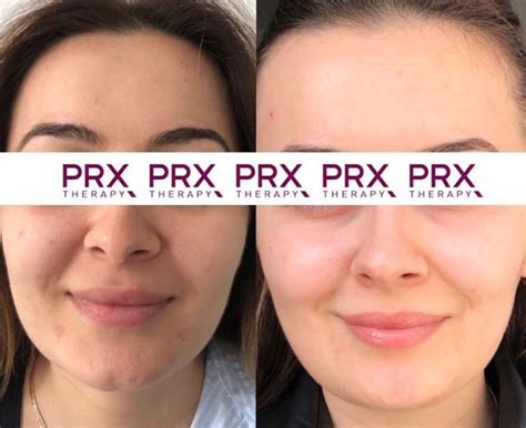 Хімічний пілінг та Prx t33 - плюси та мінуси процедур - PRX терапія