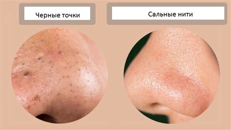 Сальные нити и черные точки: в чем разница?