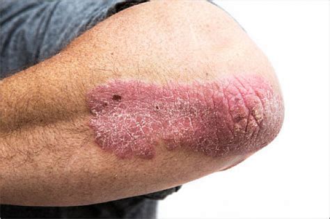 The “heartbreak of psoriasis” may affect your joints, heart, and mind ...