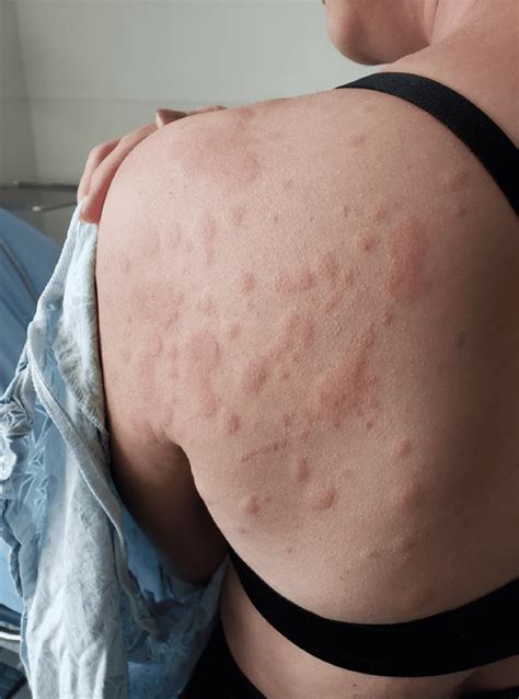 Pollen Allergy Symptoms Rash at Christopher Bryant blog
