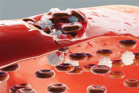How ITP Hinders Blood From Clotting