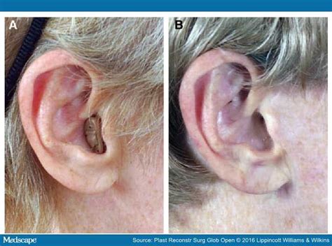 Ear Lobule Anatomy