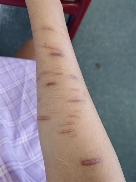 this is my right arm! : r/SelfHarmScars
