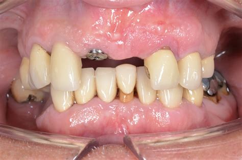 Multiple Teeth Implants - Fernlea Dental Implant Centre