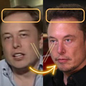 Elon Musk Hair Transplant: Before and After Transformation