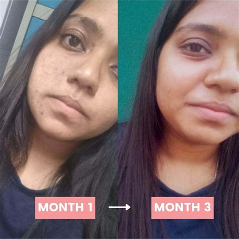 Glutathione Before And After | ubicaciondepersonas.cdmx.gob.mx