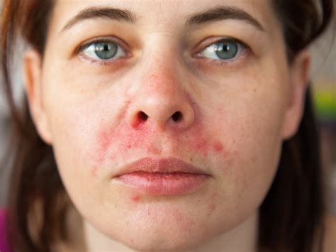 What Is Perioral Dermatitis? | Balmonds