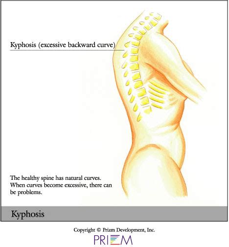 Kyphosis | Scoliosis Texas