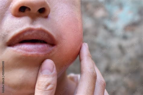 swelling   cheek  asian young man inflammation  parotid gland
