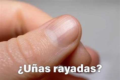 ¿Uñas rayadas verticalmente? Causas habituales y tratamiento