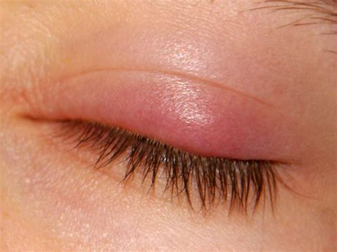 Home Eye Stye Treatment Chalazion Treatment Eyelid