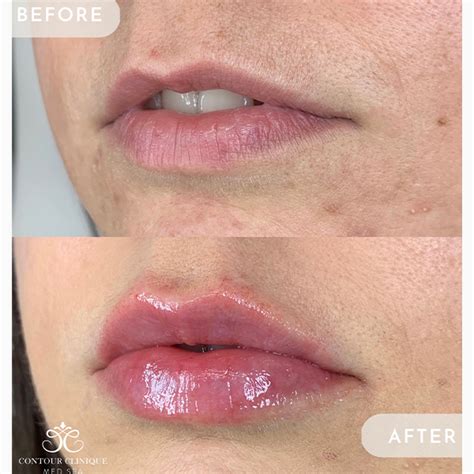 Lip Pump - Contour Clinique Med Spa