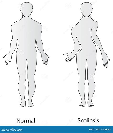 Scoliosis stock vector. Illustration of spine, pain, disability - 41217367