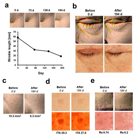 Enhancement of Efficacy of Retinoids through Enhancing Retinoid-Induced