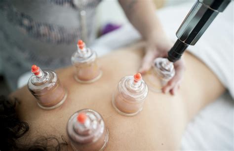 Cupping Therapy: What It Is, How It Works, and Why We Use It at