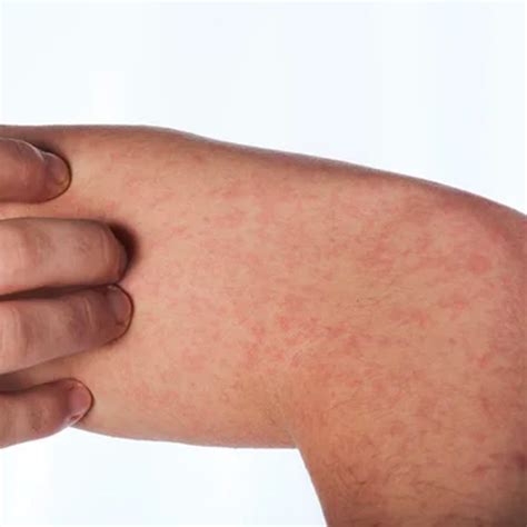 Vasculitis | Pielviva