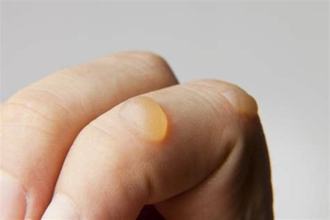 Water Blisters | LoveToKnow