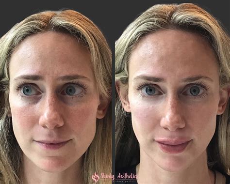 Under Eye Fillers - Before & After Results at Skinly