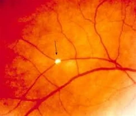 The three early signs of high cholesterol you can notice in your eyes ...