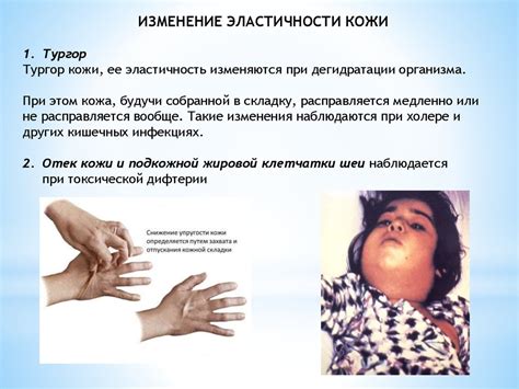 Основные клинические синдромы при инфекционных заболеваниях ...