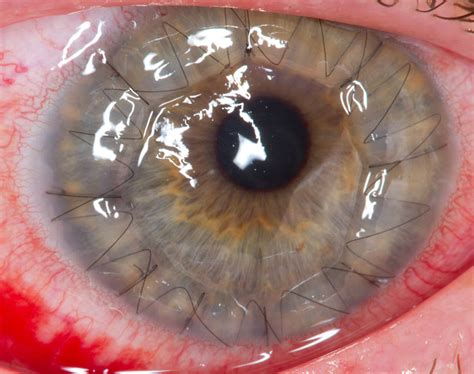 corneal transplantation   surgical procedure   damaged