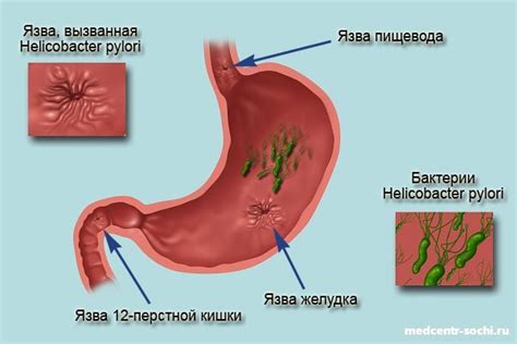 13С-уреазный дыхательный тест на Хеликобактер пилори (Helicobacter ...