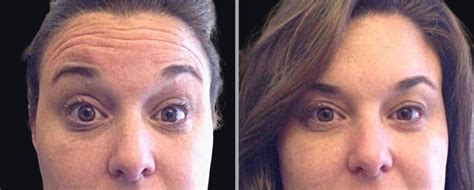 Botox , Dysport or Daxxify Before and After Pictures Houston & San Antonio
