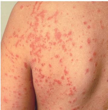 Vasculitis Symptoms Rash