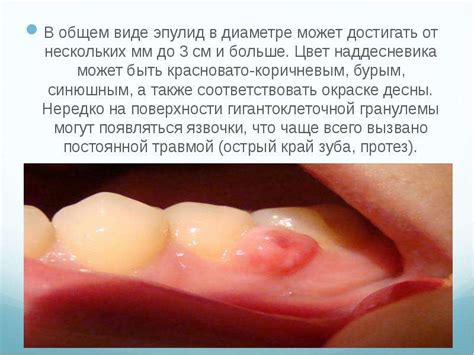 Эпулис - презентация, доклад, проект скачать