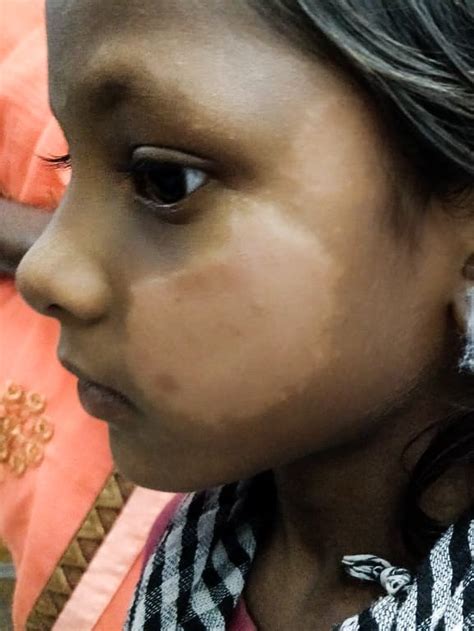 What does leprosy look like? - Leprosy Mission International