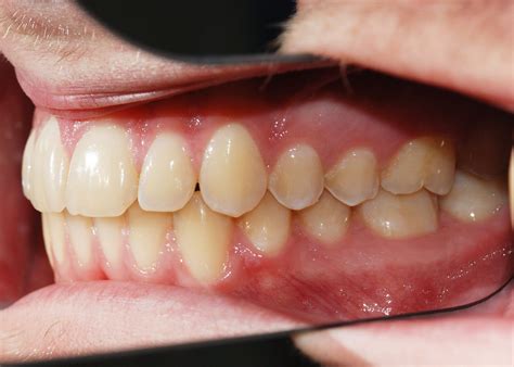 Orthodontic treatment before and after Overbite - Orthodontix