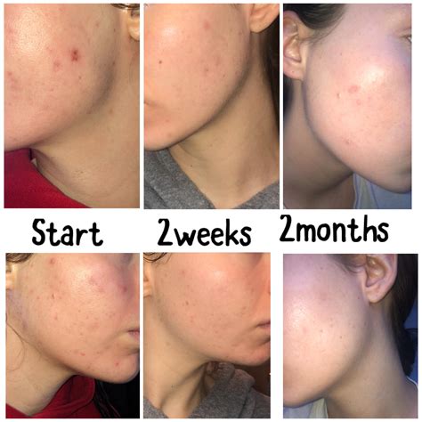 248 best Azelaic Acid images on Pholder | Skincare Addiction, Tretinoin