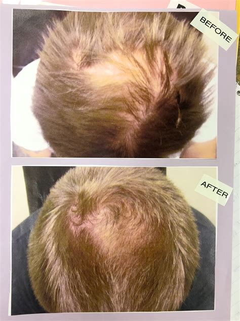 Low Light Laser Therapy Hair Growth | Shelly Lighting