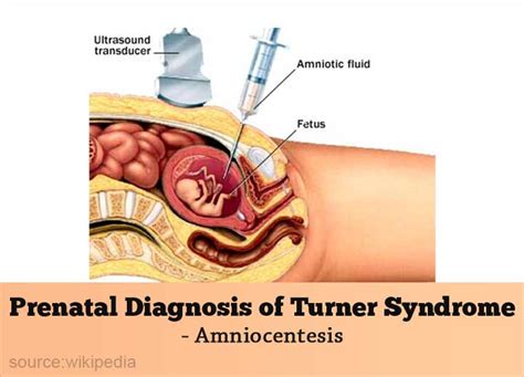 Turner Syndrome - Causes, Types, Symptoms, Diagnosis, Treatment