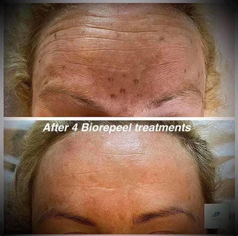 Biorepeel Reviews - How Good is the Product? - Med Supply Solutions