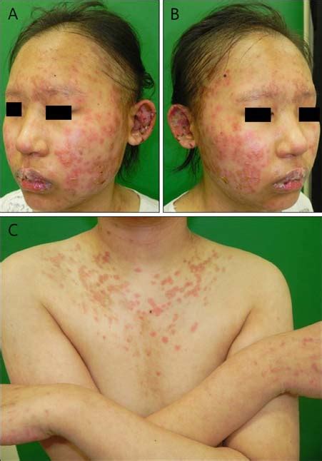 Stevens-Johnson Syndrome-Like Skin Lesions in a Patient with Juvenile ...