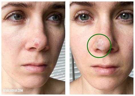 Skin Grafts For Cancer