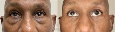 Male Facial Enhancement Before and After Pictures Case 662 | Houston ...