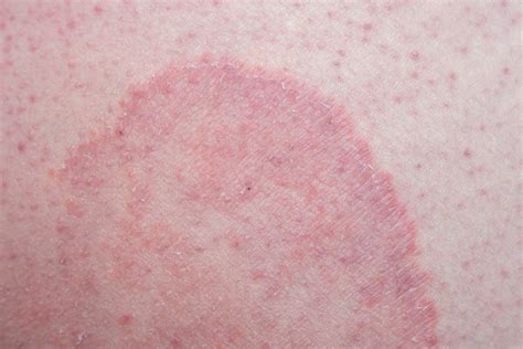 O Que É Tinea Cruris - Micose na virilha (tinea cruris): quais são as causas e como tratá-la ...