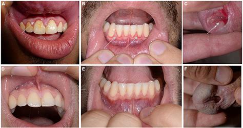 Membrane Múcasach Neamhurchóideacha Pemphigoid Mucous Membrane