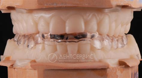 Разобщающая каппа | зуботехническая лаборатория Dentservice